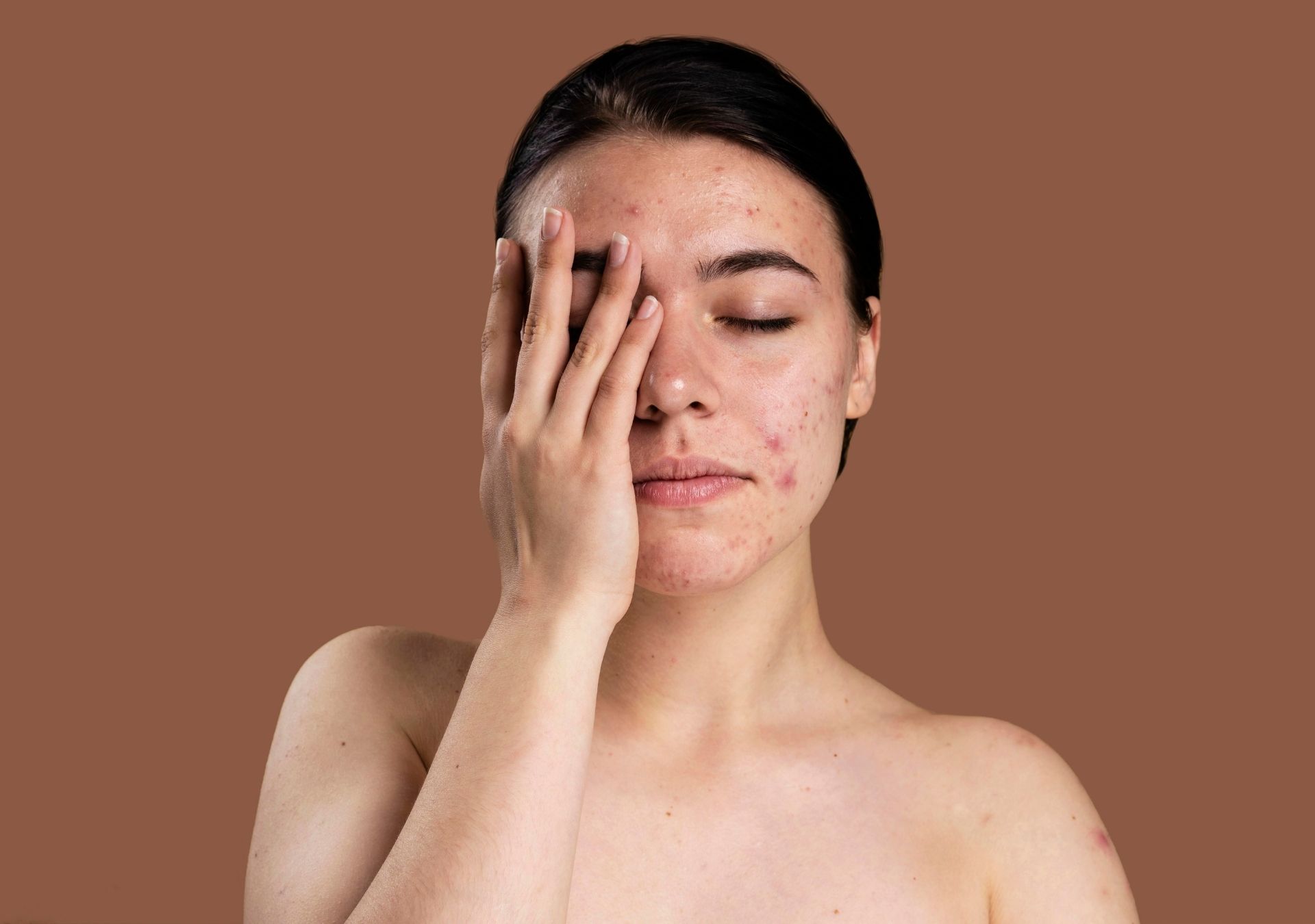 Avène lança Cleanance Comedomed Peeling e promete acelerar o tratamento da acne desde o primeiro dia